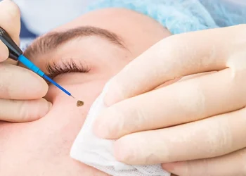 Skin Tag
